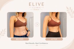 Before and after breast reconstruction surgery front view Dubai — board-certified surgeon Elive Clinic