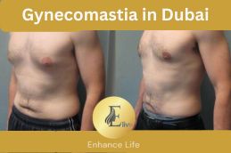 Before and After Gynecomastia in Dubai