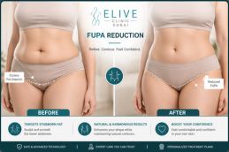 Pubic lift surgery before and after Dubai — mons pubis reduction result, Elive Clinic patient