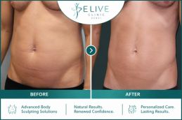 Monsplasty before and after in Dubai — sagging mons pubis correction, Elive Clinic