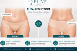 Pubic area tightening before and after — post-weight loss mons pubis lift, Elive Clinic Dubai