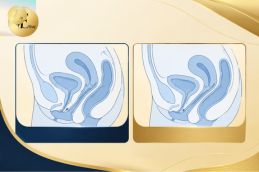 Before minimally invasive hymen reconstruction surgery Dubai female patient