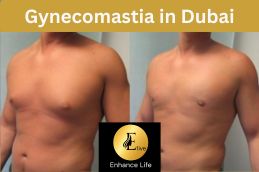 Before and After result Gynecomastia in Dubai at Elive Clinic