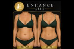 Patient after mastopexy breast lift in Dubai with lifted, firmer contours and improved nipple position at Elive Aesthetic Clinic