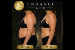 Patient before after breast lift surgery in Dubai showing sagging and drooping breasts treated at Elive Clini