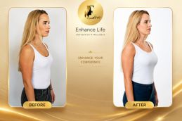 Before breast surgery in Dubai at Elive Clinic Al Quoz