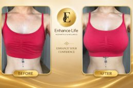 After breast surgery results at Elive Clinic Dubai — natural enhancement