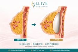 breast surgery before and after photos – intimate surgery results at Elive Clinic Al Quoz Dubai
