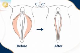 Patient before hymenoplasty surgery at board-certified intimate clinic Dubai