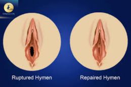 Hymen repair surgery before and after procedure photo at Elive Clinic Dubai