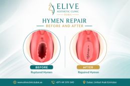 Hymen Repair before and after photos – intimate surgery results at Elive Clinic Al Quoz Dubai