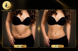 breast augmentation before after photos Elive Clinic Dubai natural results