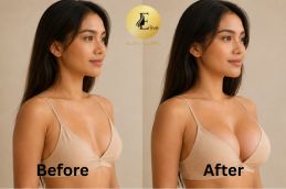Natural-looking breast augmentation before and after in Dubai — Elive Clinic DHA-licensed surgeon