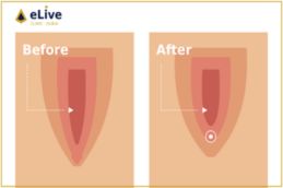 Before and after clitoral hood reduction surgery in Dubai – Elive Clinic patient result