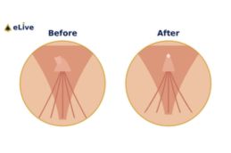 After clitoral hoodectomy surgery in Dubai – Elive Clinic patient result