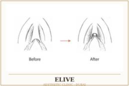 before and after hood reduction result in Dubai and Abudhabi 