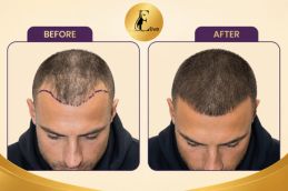 Before and after result at elive clinic Dubai