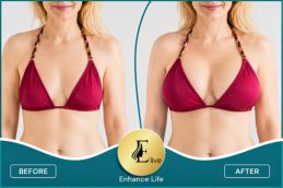 Before and after results of breast filler injections Dubai