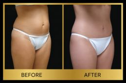 Hernia repair Before and after