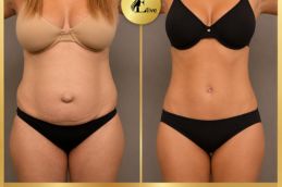 Hernia repair Before and after in Dubai