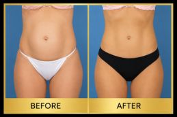 Hernia repair Before and after in Dubai & Abu Dhabi
