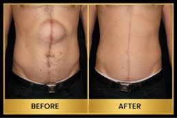 Hernia repair Surgery result in Dubai & Abu Dhabi