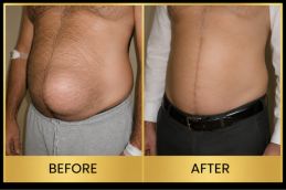 Hernia repair Surgery results in Dubai & Abu Dhabi