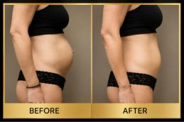 Hernia repair results in Dubai & Abu Dhabi