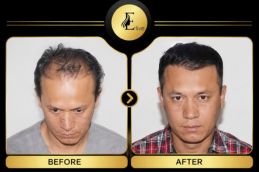 before and after hair transplant at elive clinic