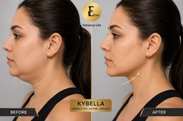 Before and after Kybella fat-dissolving injection results for double chin at Elive Clinic Dubai