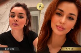 Before and after cosmetic Injectables treatment results at Elive Clinic Dubai