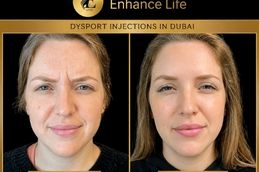 Before and After Dysport Injections Dubai