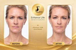 Before and After Dysport Injections Dubai & Abu Dhabi