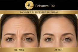 Before and After Dysport Injections Dubai UAE