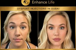 Before and After Dysport Injections UAE