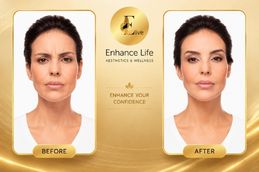 Before and After Dysport Injections