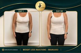 Before and After result Mounjaro injection in Dubai & Abu Dhabi