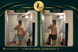Before and After result Mounjaro injection in Dubai