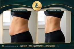 Before and After result of Mounjaro injection in Dubai & Abu Dhabi