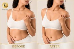 before and after result of breast reduction in Dubai