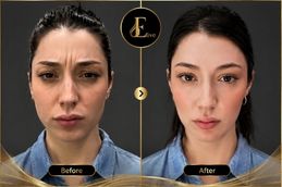 botox injections before and after in dubai