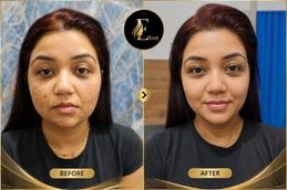 botox treatment before after dubai