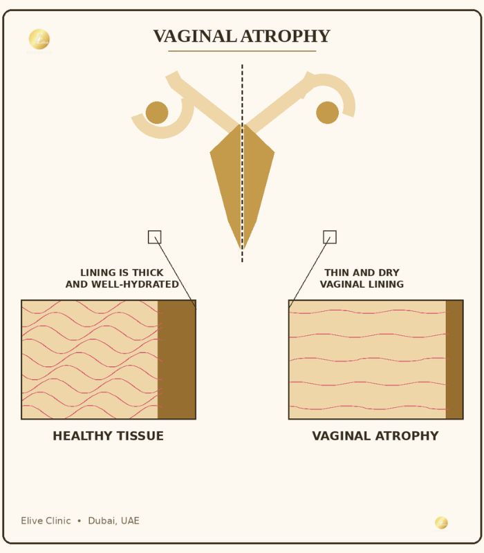 Diagram comparing healthy vaginal tissue with thin, dry tissue in vaginal atrophy - Elive Clinic Dubai