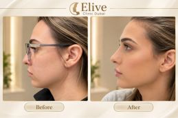 Before & AfterResults Aqualyx Injections Abu Dhabi