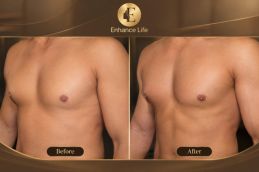 Before and after Areola Reduction Surgery in Dubai & Abu Dhabi