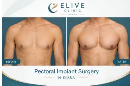 Before and after Pectorial Implant Surgery in Dubai & Abu Dhabi