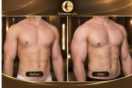 Before and after Pectorial Implant Surgery in Dubai