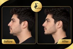 Before and after images Fat-Reduction Injections in Dubai