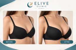 Before and after images of breast treatment in Dubai & Abu Dhabi
