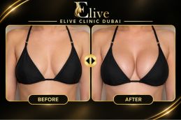 Before and after images of breast treatment in Dubai